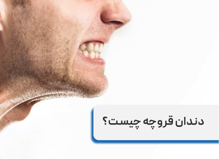 دلیل دندان قروچه در خواب چیست؟ علائم و راه های درمان دندان قروچه