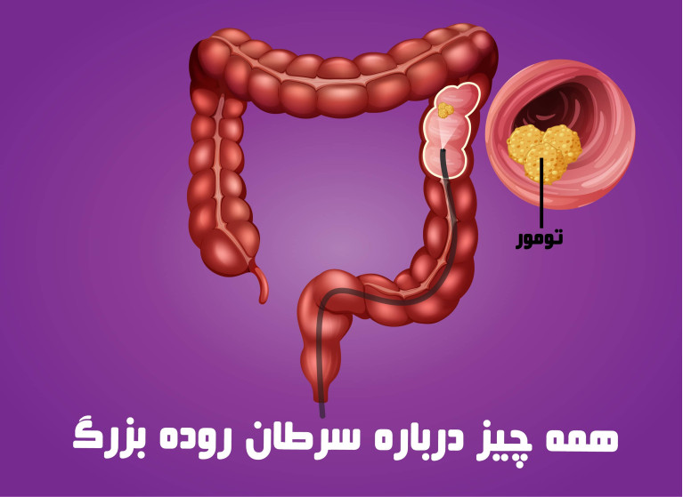 سرطان روده بزرگ چیست ؟ دلایل ابتلا, علائم و روش های درمان سرطان کلورکتال