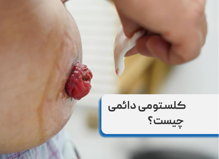 کلستومی دائمی چیست؟ هرآنچه باید بدانید