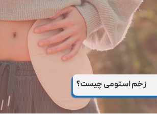 زخم استومی چیست؟ راهنمای کامل مراقبت از زخم استومی