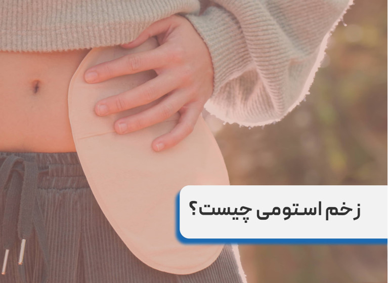 زخم استومی چیست؟ راهنمای کامل مراقبت از زخم استومی